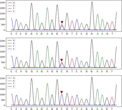 A rare case report of hemolysis in a newborn: hereditary elliptocytosis